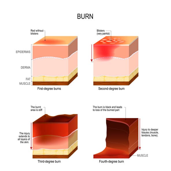 Four Degrees of Burns