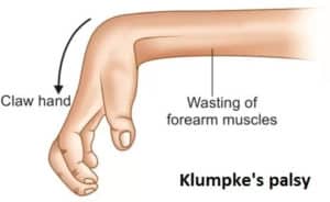 klumpkes palsy graphic