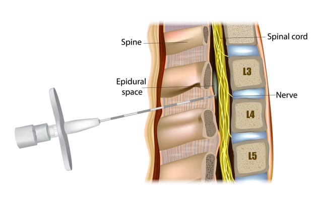 epidural graphic