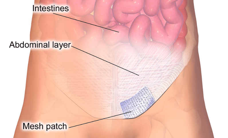 A hernia mesh placed inside the abdomen to prevent recurring hernia.